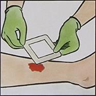 apply gently  versatile all-in-one bordered foam dressing with Safetac soft silicone wound contact layer, for treating chronic and acute wounds